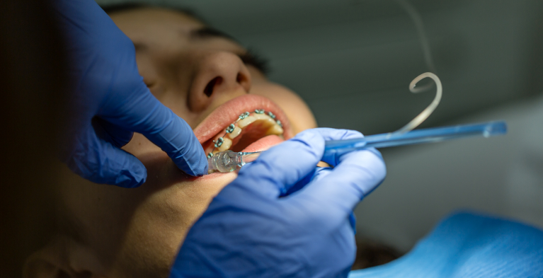 beugelbehandeling bij de orthodontist