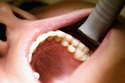 poster cariës/gaatjes