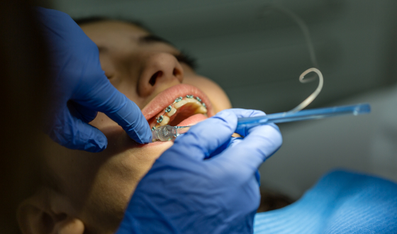 beugelbehandeling bij de orthodontist