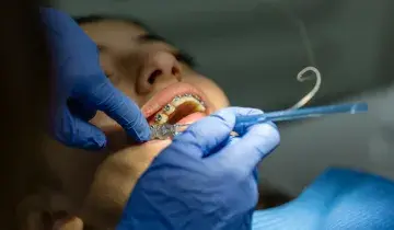 beugelbehandeling bij de orthodontist